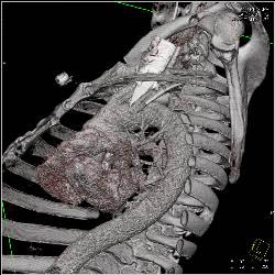 Stab Wound With Broken Blade in Chest Causing Artifact - CTisus CT Scan