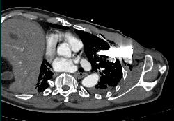 Stab Wound With Broken Blade in Chest Causing Artifact - CTisus CT Scan