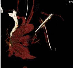 Stab Wound With Broken Blade in Chest Causing Artifact - CTisus CT Scan