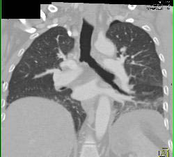 Occluded Right Mainstem Bronchus - CTisus CT Scan