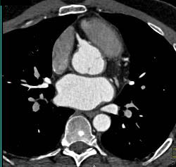 Dilated Reimplanted RCA and Left Main Coronary Artery in Multiple Sequences - CTisus CT Scan