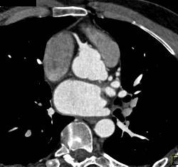 Dilated Reimplanted RCA and Left Main Coronary Artery in Multiple Sequences - CTisus CT Scan