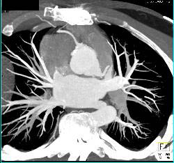 Dilated Reimplanted RCA and Left Main Coronary Artery in Multiple Sequences - CTisus CT Scan