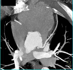 Dilated Reimplanted RCA and Left Main Coronary Artery in Multiple Sequences - CTisus CT Scan