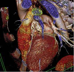 Dilated Reimplanted RCA and Left Main Coronary Artery in Multiple Sequences - CTisus CT Scan