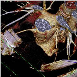 Dilated Reimplanted RCA and Left Main Coronary Artery in Multiple Sequences - CTisus CT Scan