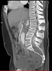 Marfan With Dural Ectasia and Dilated Aortic Root - CTisus CT Scan