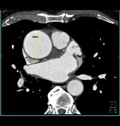 Marfan With Dural Ectasia and Dilated Aortic Root - CTisus CT Scan