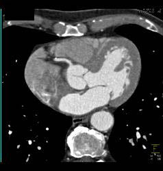 Normal Aortic Root - CTisus CT Scan