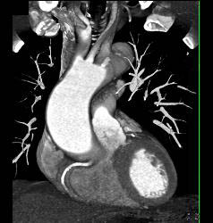 Dilated Aortic Root - CTisus CT Scan