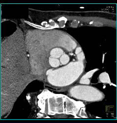 Normal Aortic Valve - CTisus CT Scan