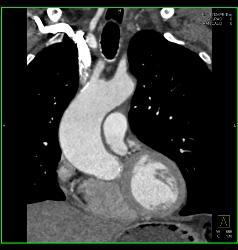 Dilated Aortic Root and Normal Valve - CTisus CT Scan