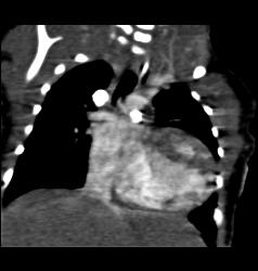 Patent Stent in Pulmonary Artery - CTisus CT Scan