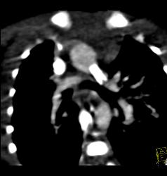 Patent Stent in Pulmonary Artery - CTisus CT Scan