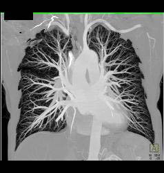 MIP Display of Pulmonary Vascularity - CTisus CT Scan