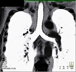 Virtual Bronchoscopy With Granulomatous Disease - CTisus CT Scan