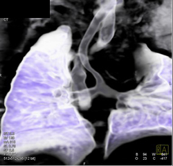 Pulmonary Sling - CTisus CT Scan