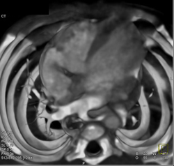 Pulmonary Sling - CTisus CT Scan