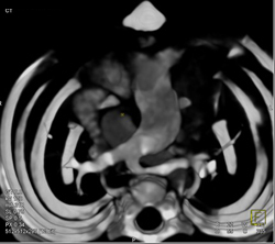 Pulmonary Sling - CTisus CT Scan