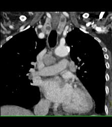 Mediastinal Nodes and Goiter - CTisus CT Scan