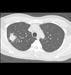 Bronchoalveolar Carcinoma (BAC) - CTisus CT Scan