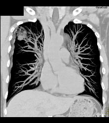 Bronchoalveolar Carcinoma (BAC) - CTisus CT Scan