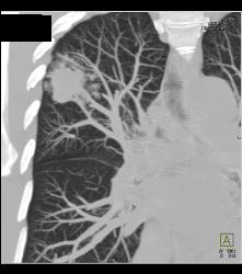 Bronchoalveolar Carcinoma (BAC) - CTisus CT Scan