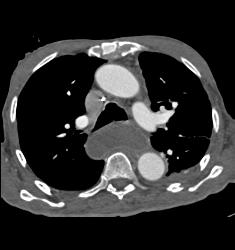 Achalasia - CTisus CT Scan