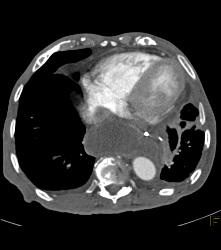 Achalasia - CTisus CT Scan