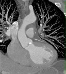 Calcified Aortic Valve With Aortic Stents - CTisus CT Scan