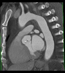 Calcified Aortic Valve With Aortic Stents - CTisus CT Scan