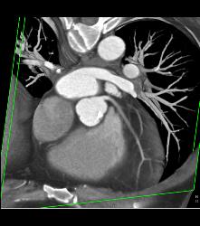 Calcified Aortic Valve With Aortic Stents - CTisus CT Scan