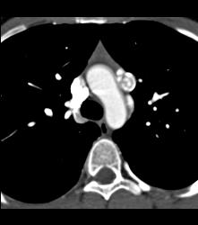 Calcified Lymphoma - CTisus CT Scan