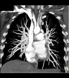 Calcified Lymphoma - CTisus CT Scan