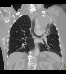 Small Cell Lung Cancer Encases the Left Mainstem Bronchus - CTisus CT Scan