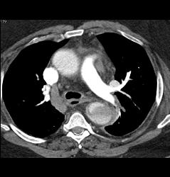Type B Dissection - CTisus CT Scan