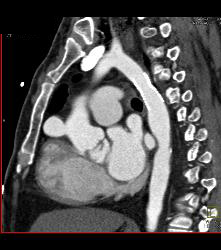 Pseudoaneurysm Off Aorta - CTisus CT Scan
