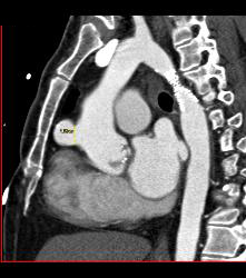 Pseudoaneurysm Off Aorta - CTisus CT Scan