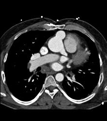 Pseudoaneurysm Off Aorta - CTisus CT Scan