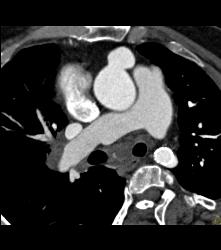 Pseudoaneurysm Off Aorta - CTisus CT Scan