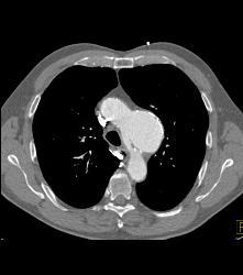 Ductus Aneurysm With Dissection - CTisus CT Scan