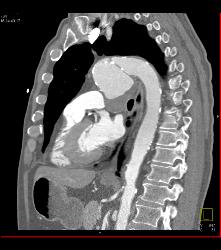 Ductus Aneurysm With Dissection - CTisus CT Scan