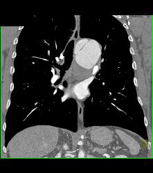 Ductus Aneurysm With Dissection - CTisus CT Scan