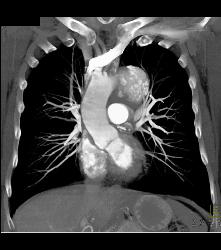 Ductus Aneurysm With Dissection - CTisus CT Scan