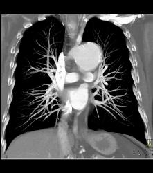 Ductus Aneurysm With Dissection - CTisus CT Scan