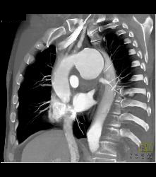 Ductus Aneurysm With Dissection - CTisus CT Scan