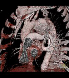 Ductus Aneurysm With Dissection - CTisus CT Scan