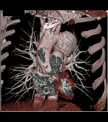 Ductus Aneurysm With Dissection - CTisus CT Scan