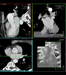 Bicuspid Aortic Valve - CTisus CT Scan