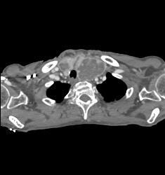 Goiter - CTisus CT Scan